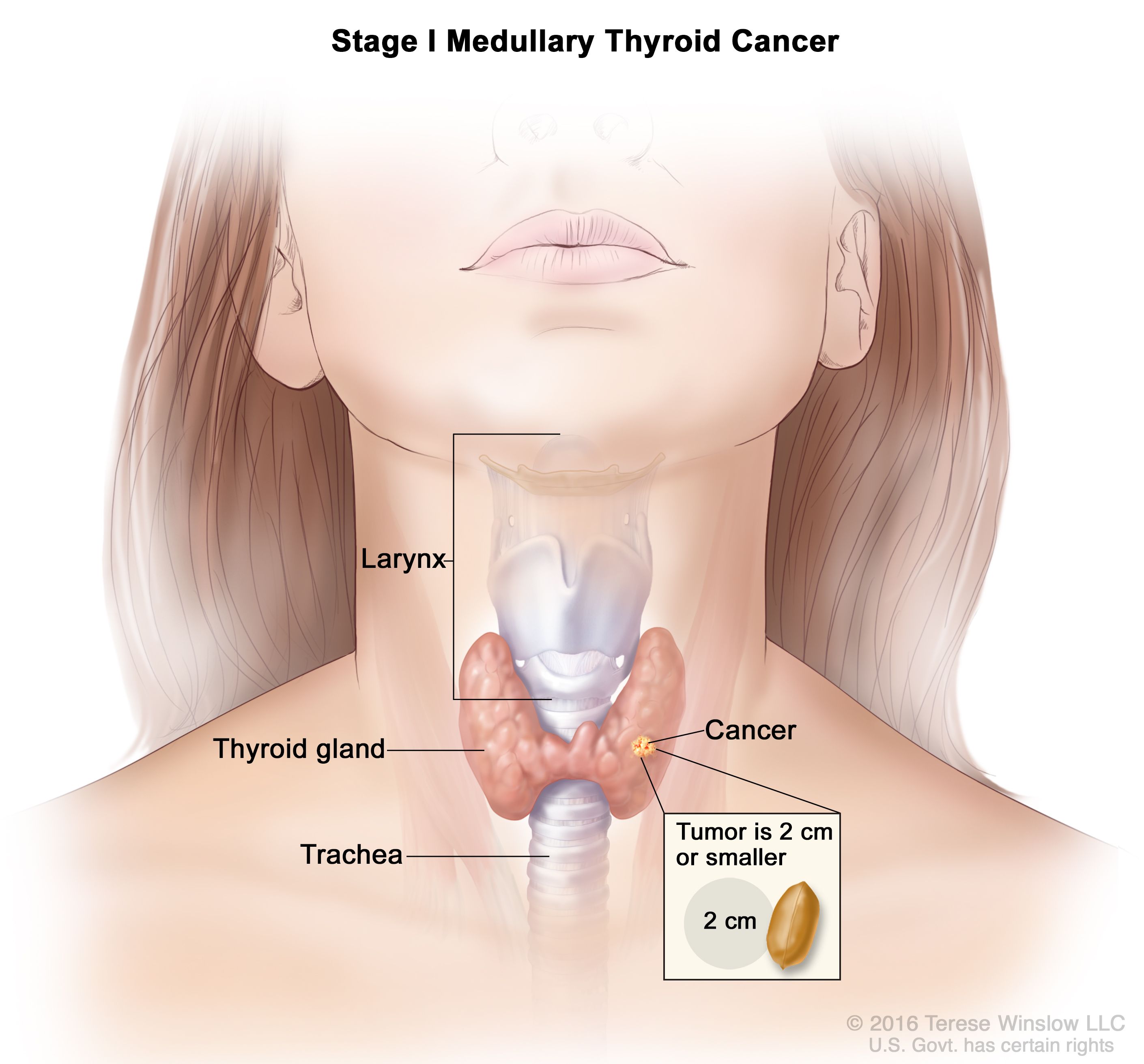 Thyroid cancer
