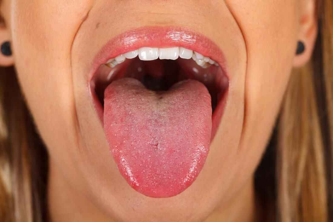 Tongue cancer